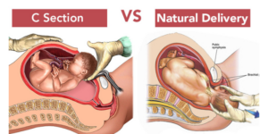 C Section Vs Normal Delivery