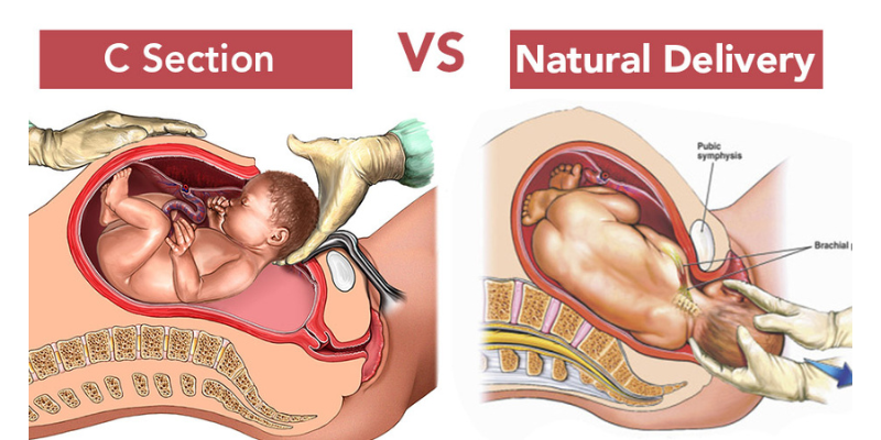 C Section Vs Normal Delivery